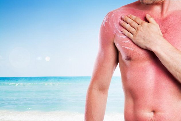 Relieve sunburn